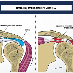 Упражнения при восстановлении плече-лопаточного ритма при импинджмент-синдроме